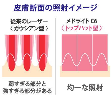 レーザートーニングの紹介画像
