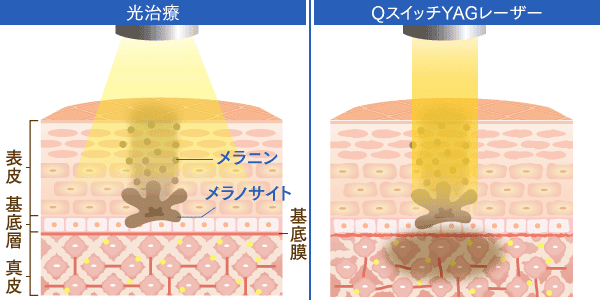 光治療とQスイッチYAGレーザーの比較画像