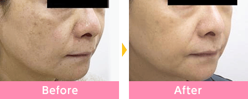 シミ取りの症例画像