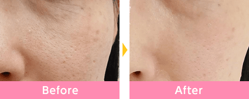 シミ取りの症例画像